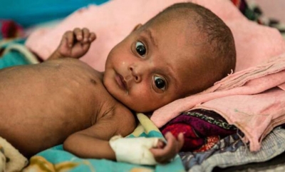 “Save the Children” ngre alarmin: 5 fëmijë vdesin çdo minutë nga uria