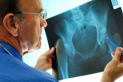 Gjashtë shenjat paralajmëruese të Osteoporozës – Si ta shmangni