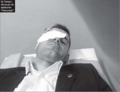 Gjyqtari anësor Ilir Tartari me 3 të qepura: Ju tregoj dhunën në Vlorë