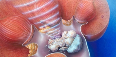 Antibiotikët rrisin rrezikun e zhvillimit të gurëzve në veshka