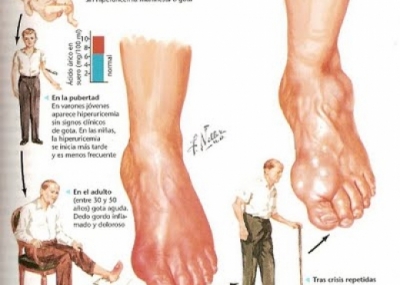 Artriti, rëndësia e njohjes dhe diagnostikimit të hershëm