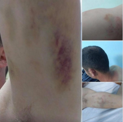 Shkoi të bëjë kallzim në Komisariat, policia rreh barbarisht pedagogun në Lushnjë