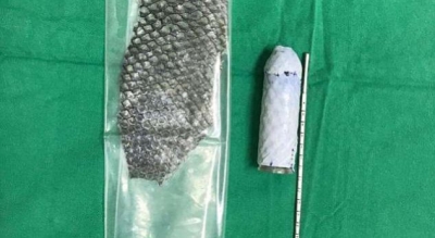 23 vjeçarja e lindur pa vaginë, e para në botë që i formohet me lëkurë peshku
