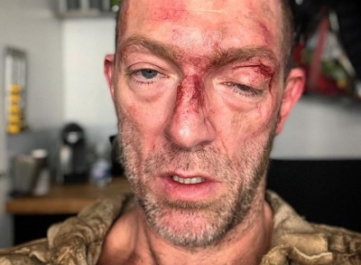 Vincent Cassel shokon fansat, fotografohet me fytyrë të gjakosur